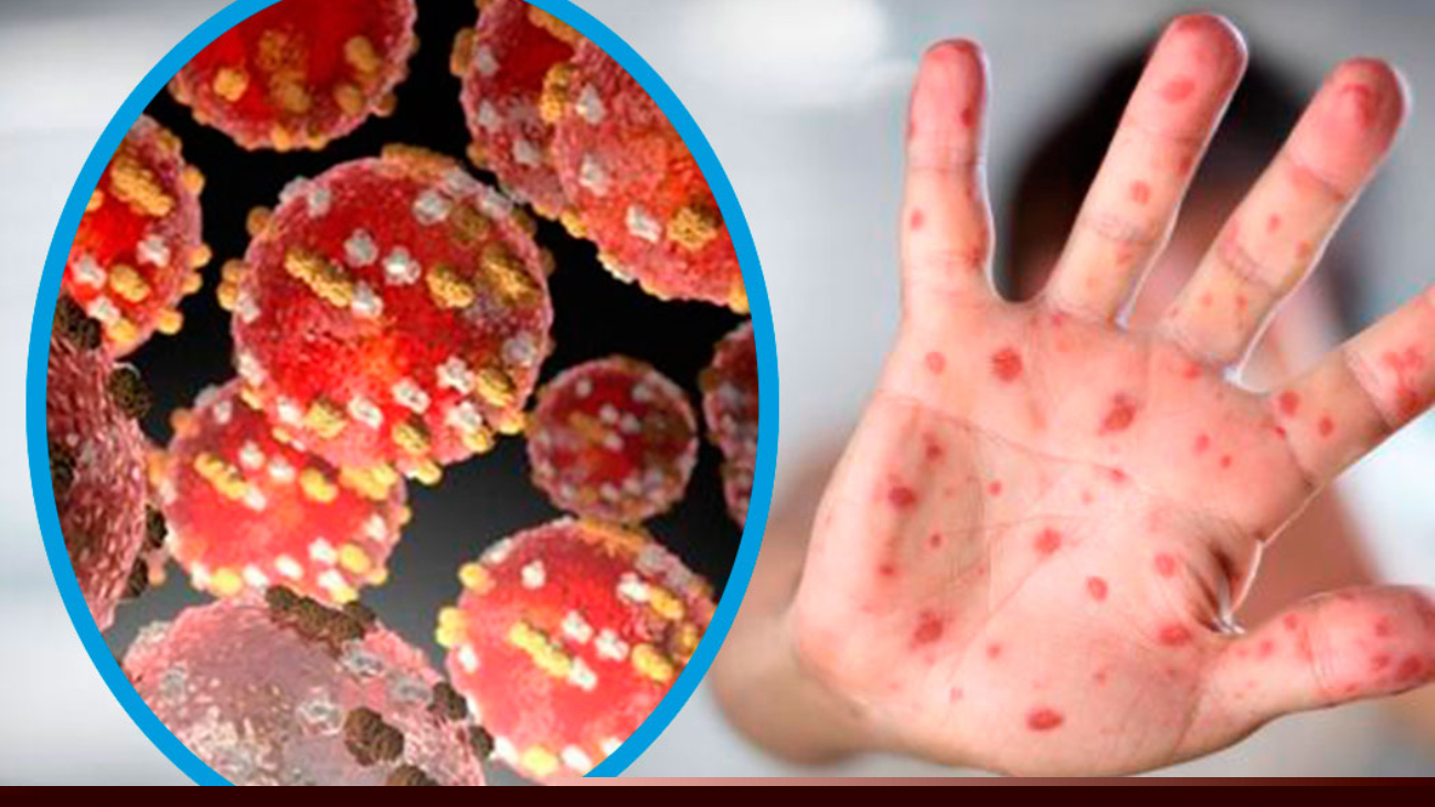 El brote de viruela del mono alcanza los 257 casos confirmados en todo el mundo, según la OMS